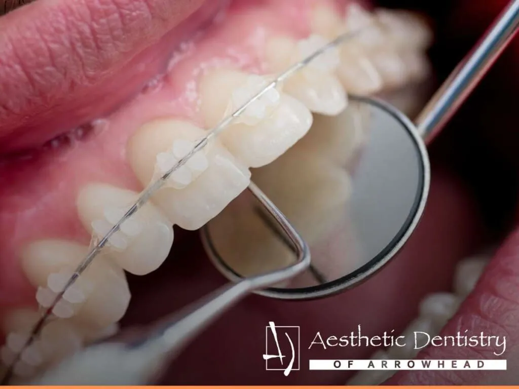 Close-up of braces being adjusted at Aesthetic Dentistry of Arrowhead