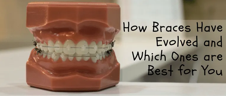 How braces have evolved and which ones are best for you