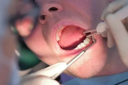 All-on-4 dental implants before and after transformation in Glendale