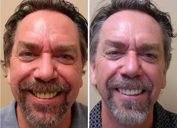 Male Patient With Teeth Whitening