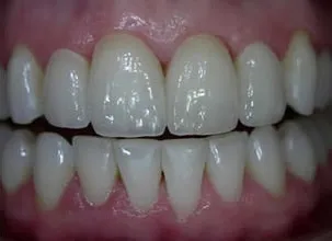 Female Patient Dental Transformation After