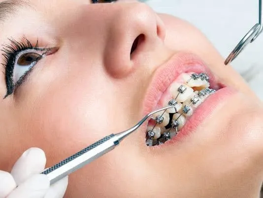 Affordable Arrowhead braces at Aesthetic Dentistry of Arrowhead