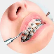 Braces — Glendale AZ
