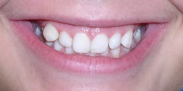 Glendale AZ Braces Othodontics Before