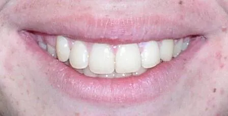 Glendale Overbite Orthodontics After