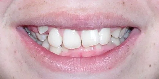Glendale Overbite Orthodontics Before