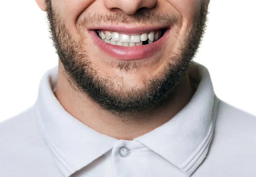 Man smiling, a candidate for dental implants in Glendale