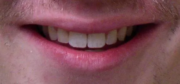 After Orthodontic Treatment