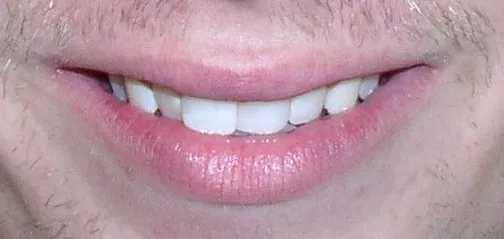 Misaligned Teeth Orthodontic Braces North Phoenix Before