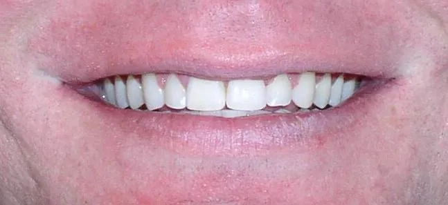 After Orthodontic Treatment