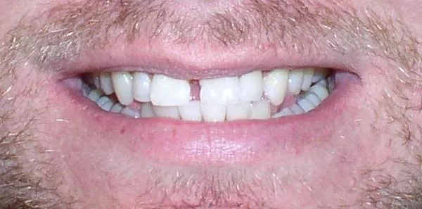 Misaligned Teeth Orthodontic Dentist Braces Before