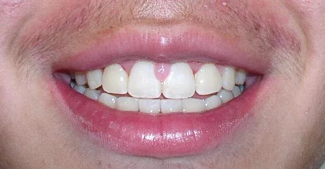 North Phoenix Overbite Correction Orthodontics After