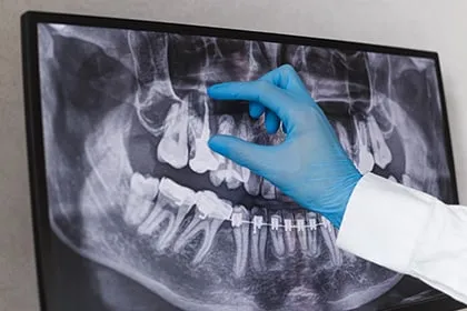 Quality Tooth Implants On Dental X-Ray