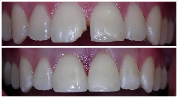 Before And After Dental Bonding On Cracked Tooth