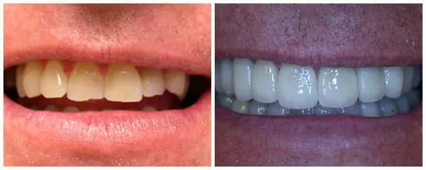 Before And After Dental Veneers