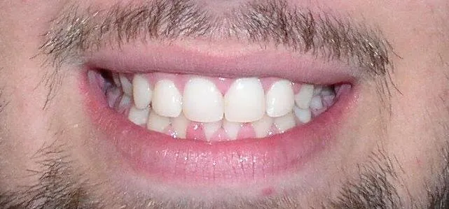 Spacer Expansion Tooth Dental After