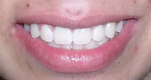 Underbite Orthodontic Procedure Peoria AZ After