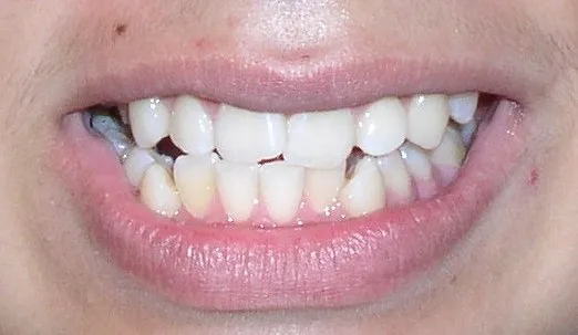 Underbite Orthodontic Procedure Peoria AZ Before
