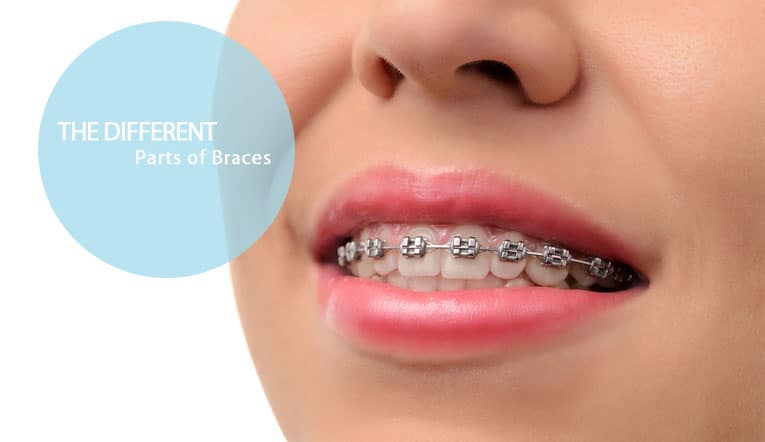 The Different Parts of Braces