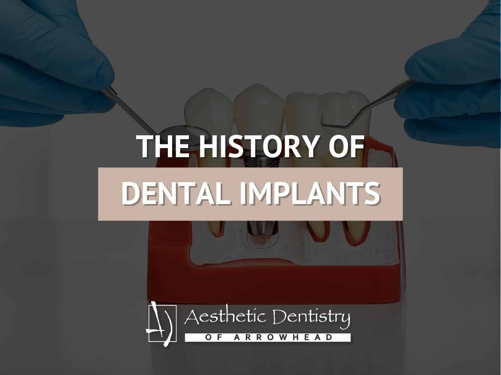 The History of Dental Implants