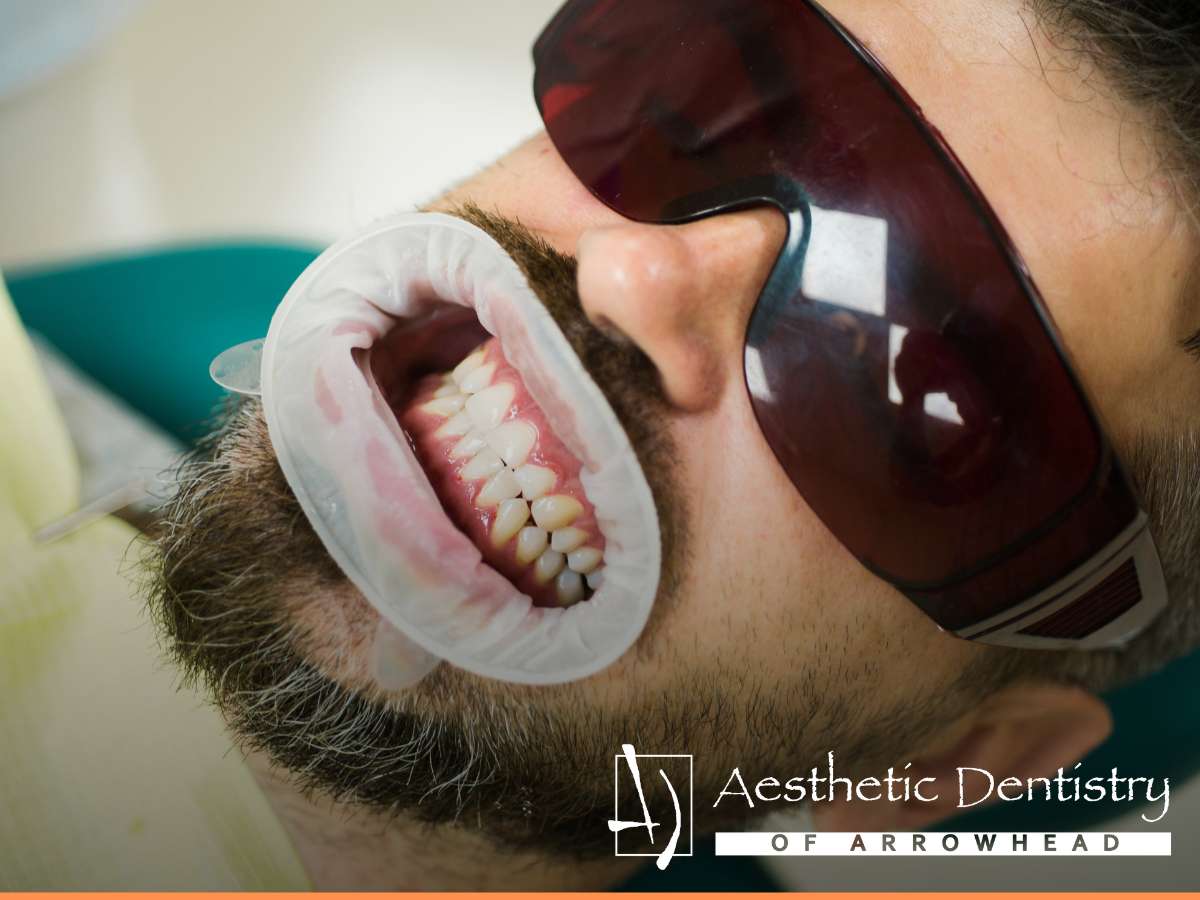 Are There Whitening Options For Teeth With Fillings
