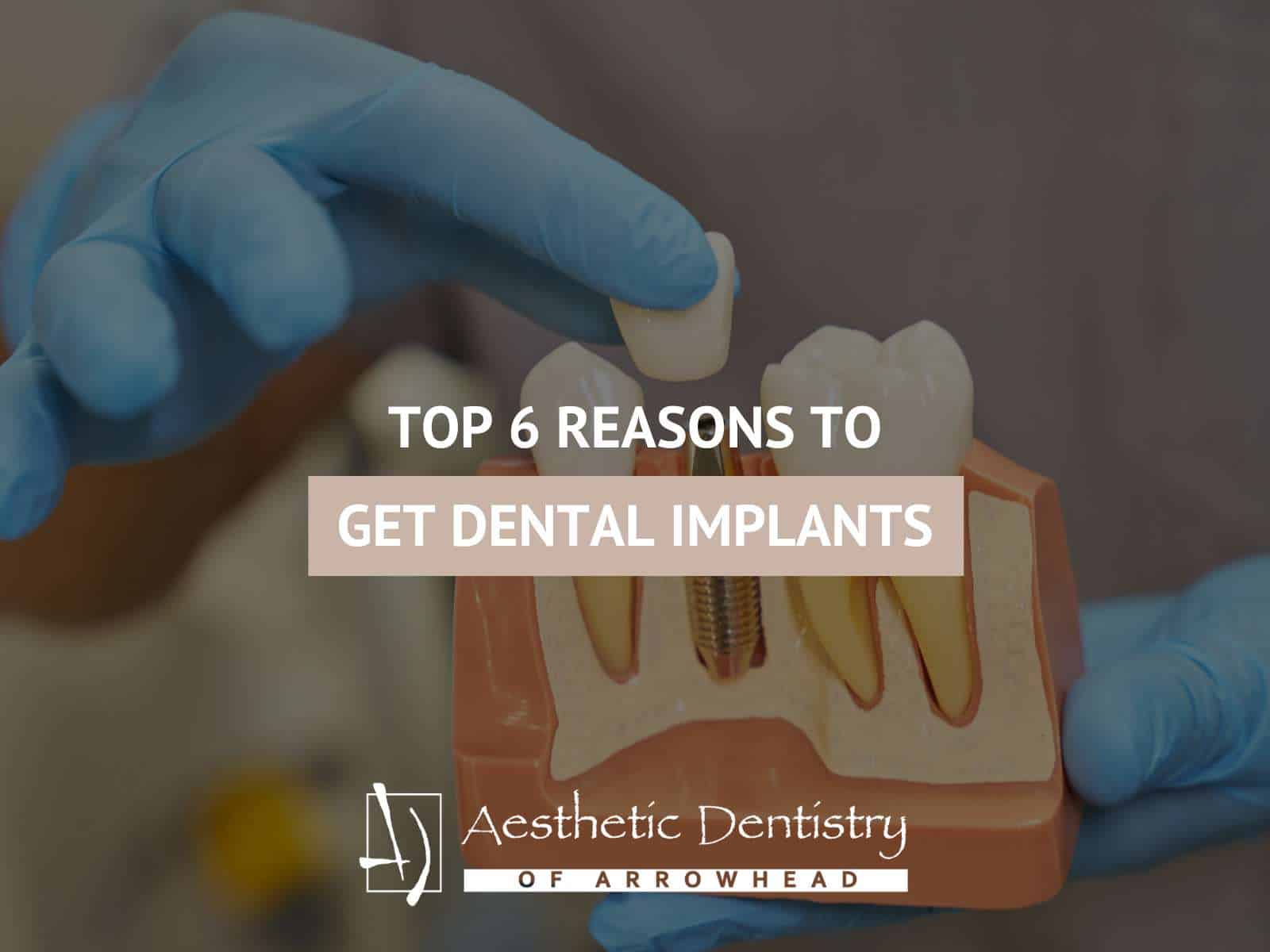 Top 6 Reasons To Get Dental Implants
