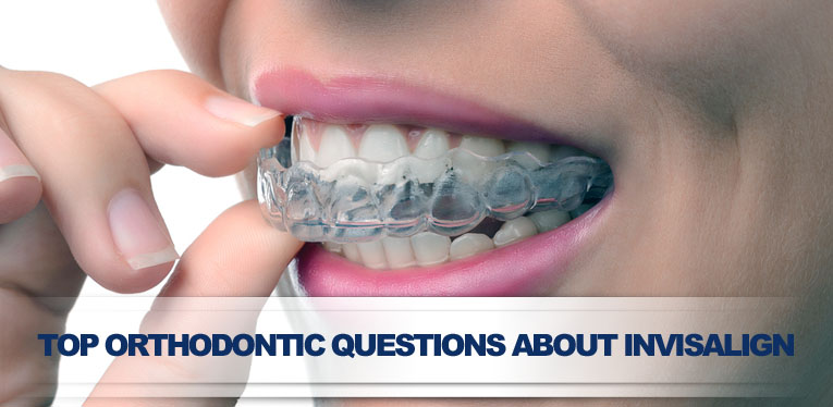 Orthodontic Questions Invisalign