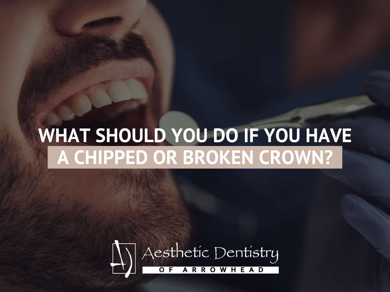 What Should You Do If You Have A Chipped Or Broken Crown?