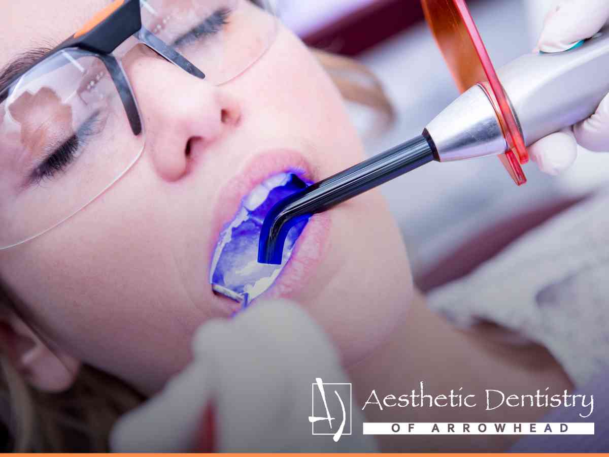 How Long Do White Dental Fillings Typically Last