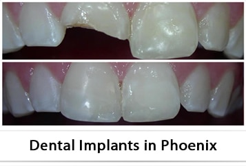 Dental Implants in Phoenix